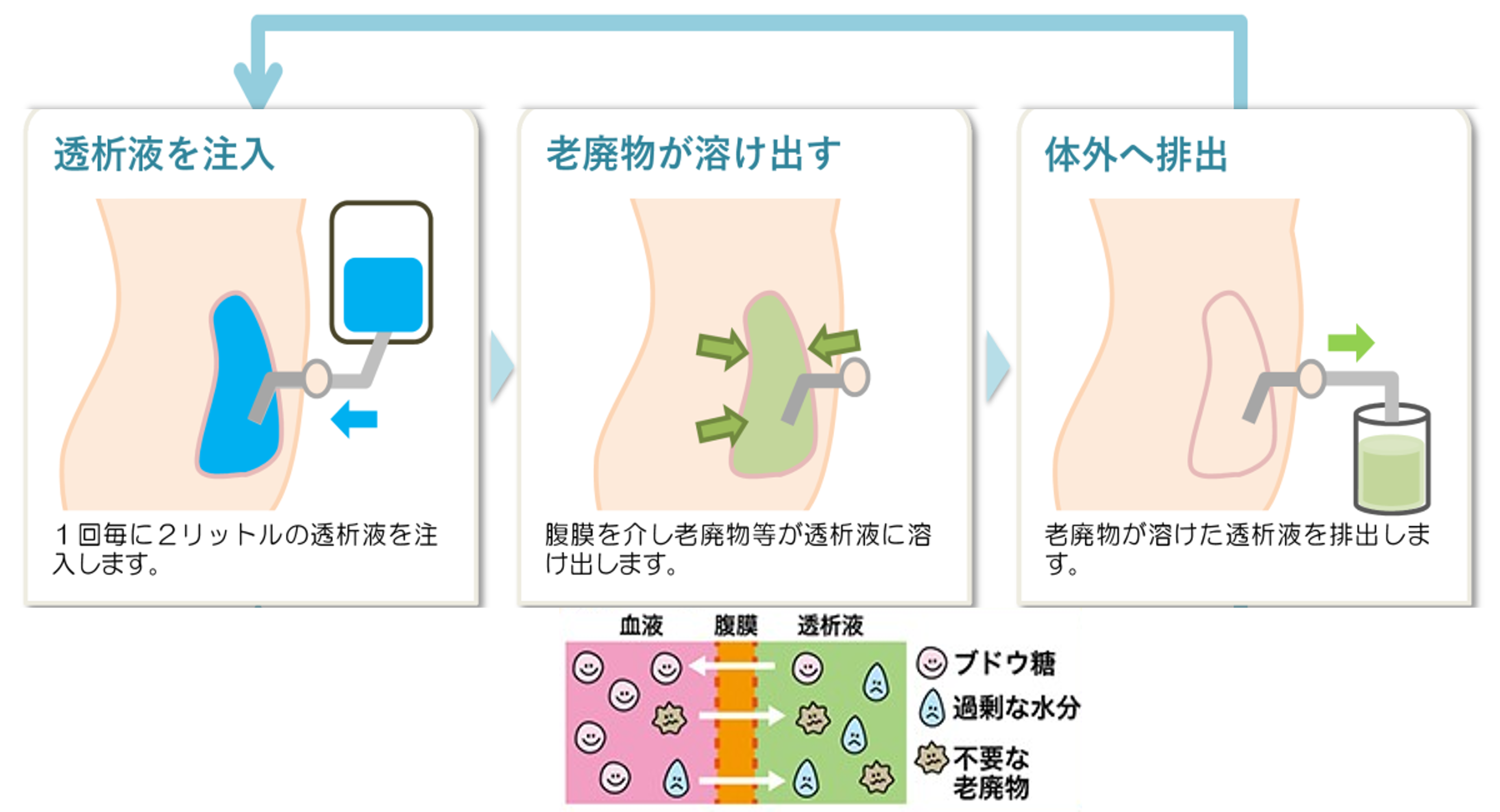 腹膜透析